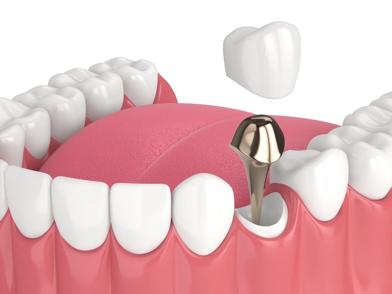 Full Mouth dental implants